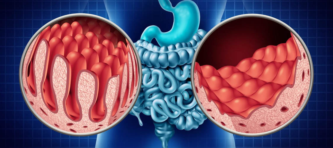 Celiac Disease: Symptoms & How It's Treated