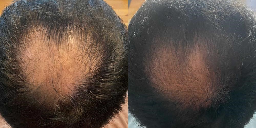 medical hair restoration