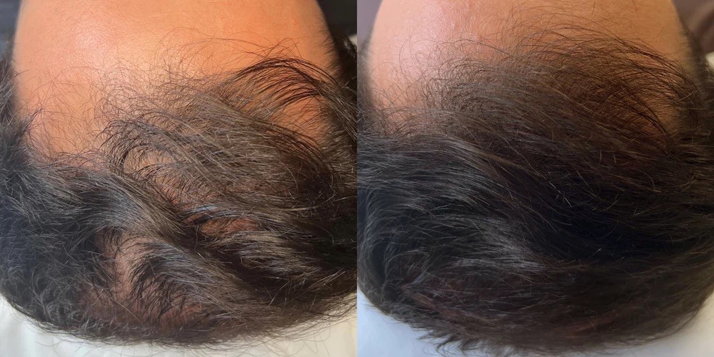 medical hair restoration